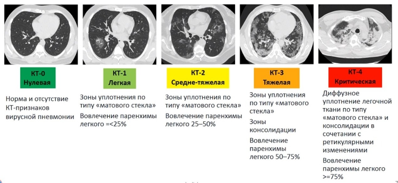кт легких во время коронавируса
